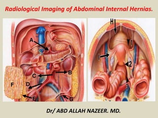 Radiological Imaging of Abdominal Internal Hernias.
Dr/ ABD ALLAH NAZEER. MD.
 