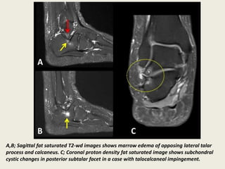 Presentation1, radiological imaging of lateral hindfoot impingement. | PPTX
