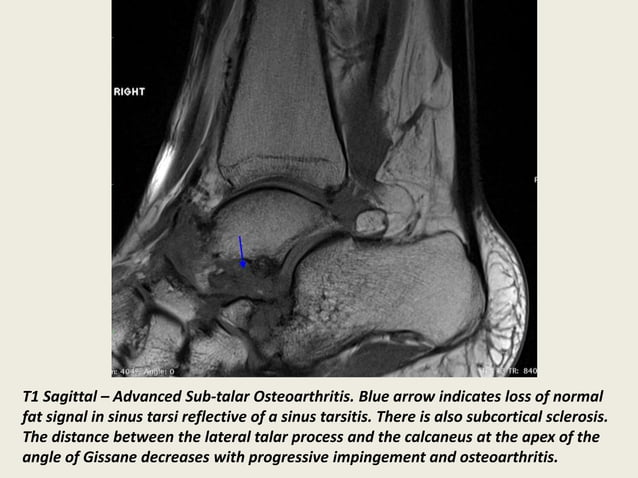 Presentation1, radiological imaging of lateral hindfoot impingement. | PPT