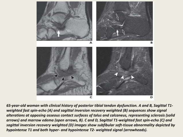 Presentation1, radiological imaging of lateral hindfoot impingement. | PPT
