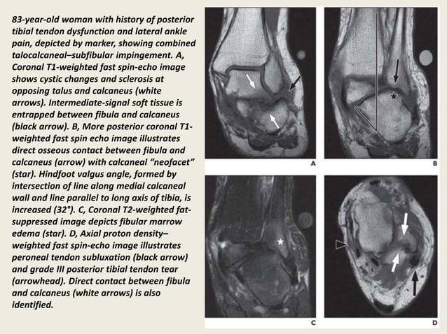 Presentation1, radiological imaging of lateral hindfoot impingement. | PPT