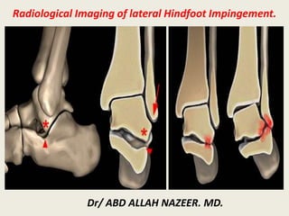 Radiological Imaging of lateral Hindfoot Impingement.
Dr/ ABD ALLAH NAZEER. MD.
 