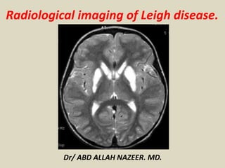 Radiological imaging of Leigh disease.
Dr/ ABD ALLAH NAZEER. MD.
 