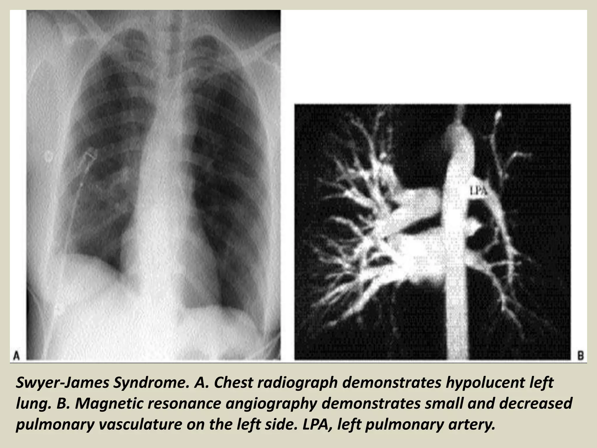 Presentation1, radiological imaging of macleod syndrome. | PPTX