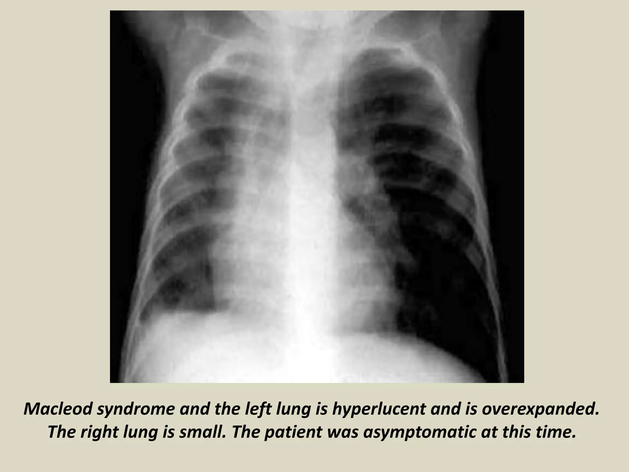 Presentation1, radiological imaging of macleod syndrome. | PPTX