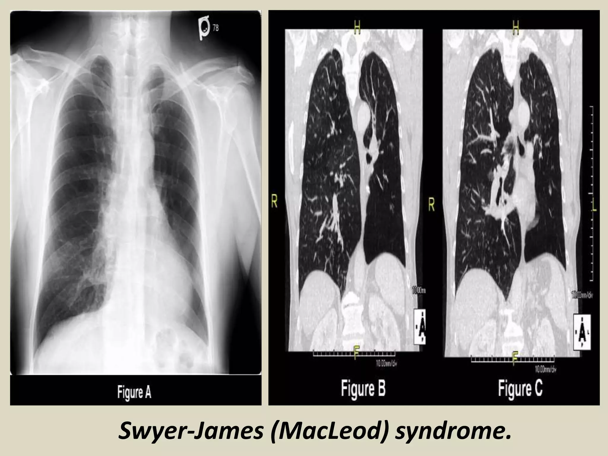 Presentation1, radiological imaging of macleod syndrome. | PPTX