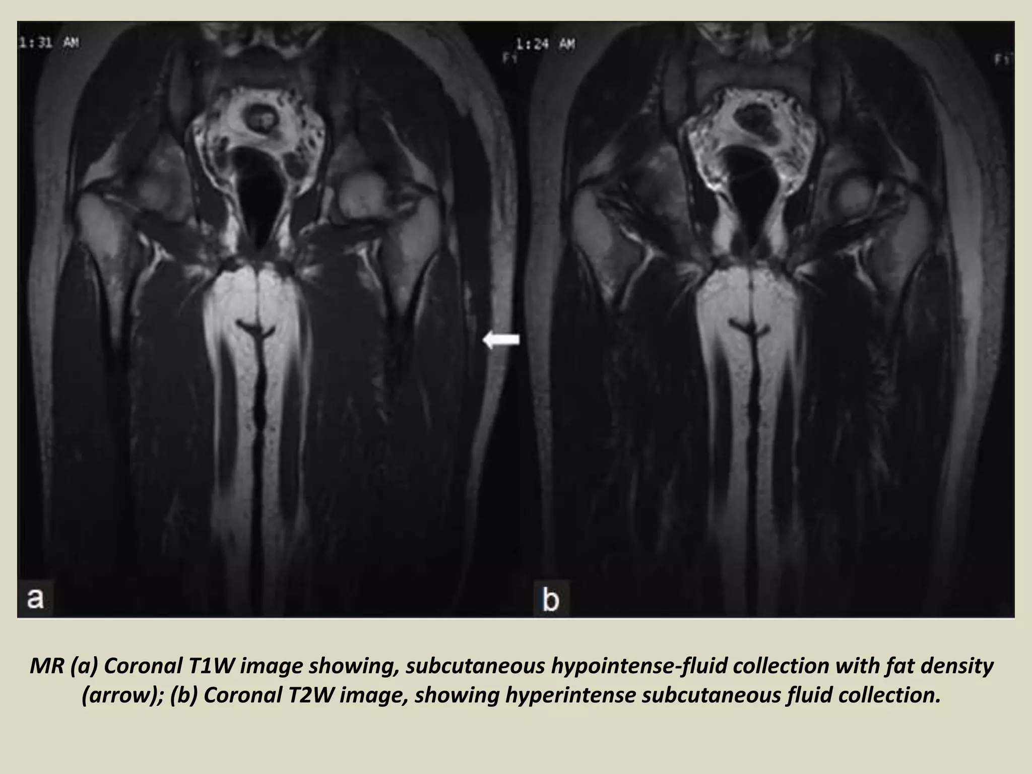 Presentation1, radiological imaging of morel lavallee lesion. PPT