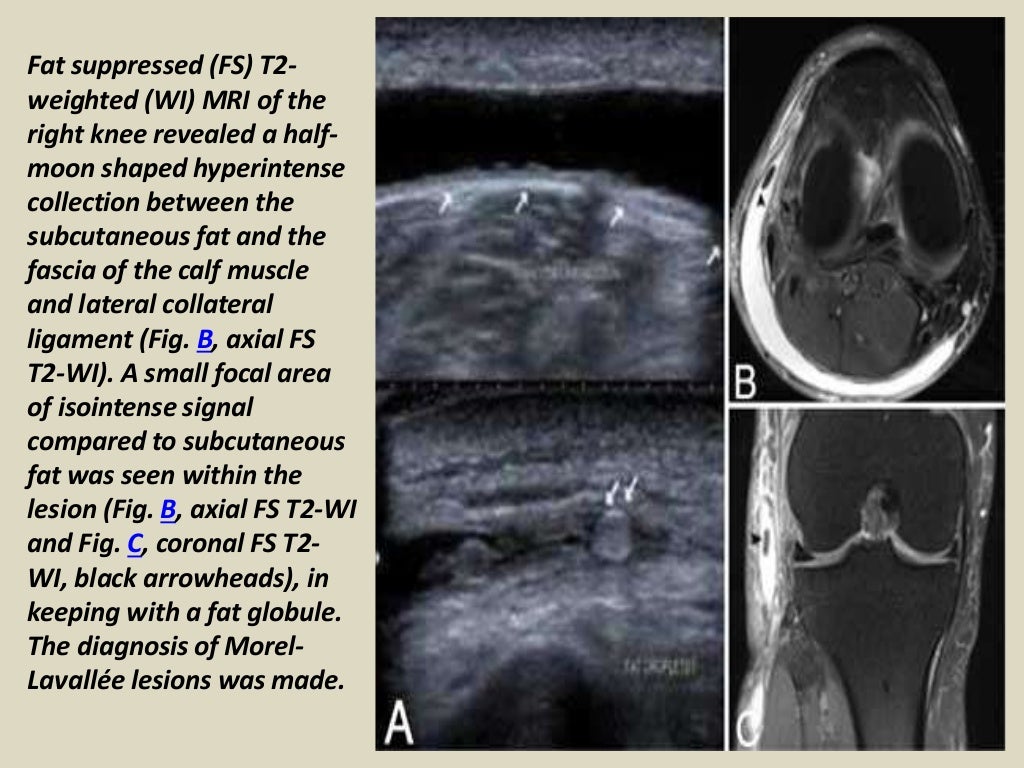 Presentation1, radiological imaging of morel lavallee lesion.