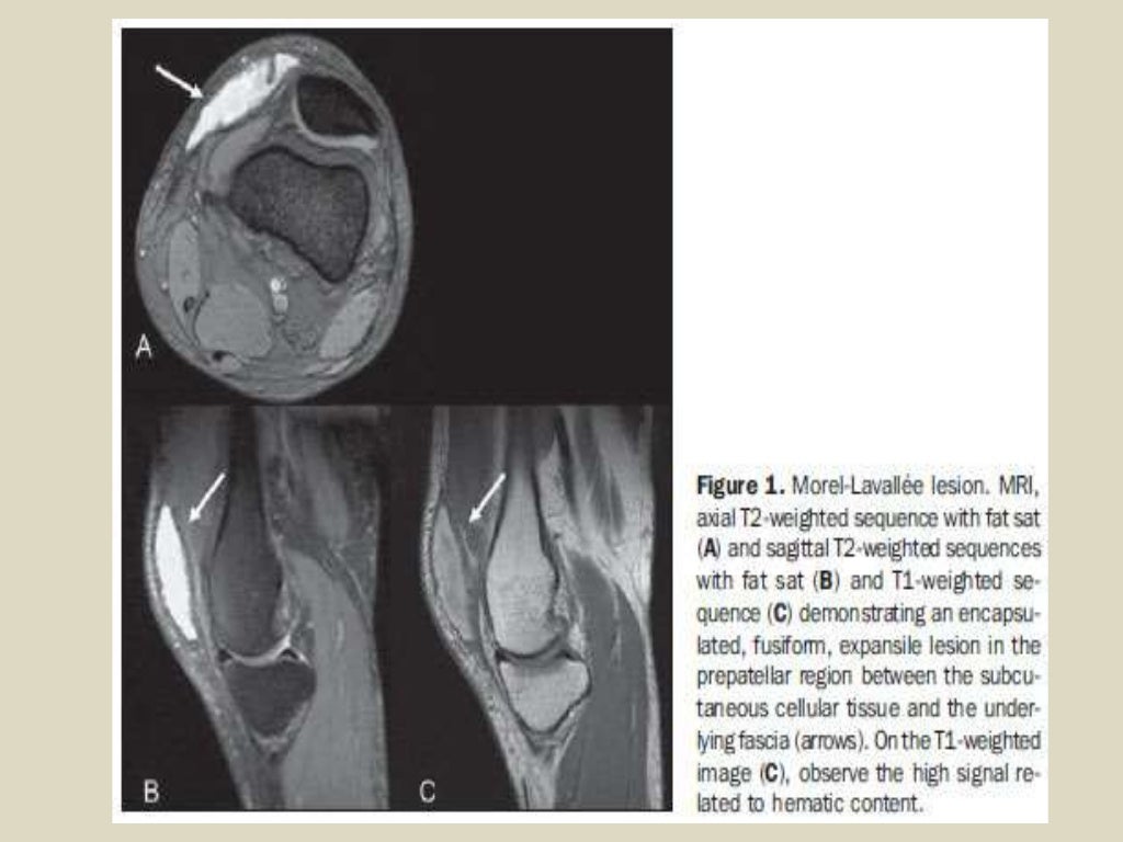 Presentation1, radiological imaging of morel lavallee lesion.