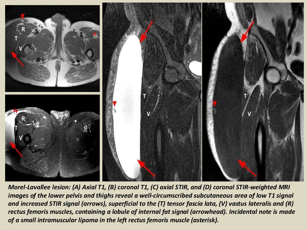 Presentation1, radiological imaging of morel lavallee lesion.