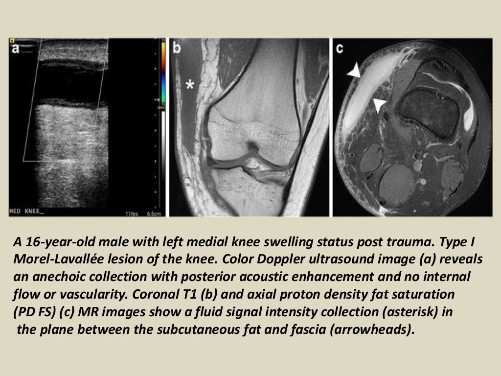 Presentation1, radiological imaging of morel lavallee lesion.