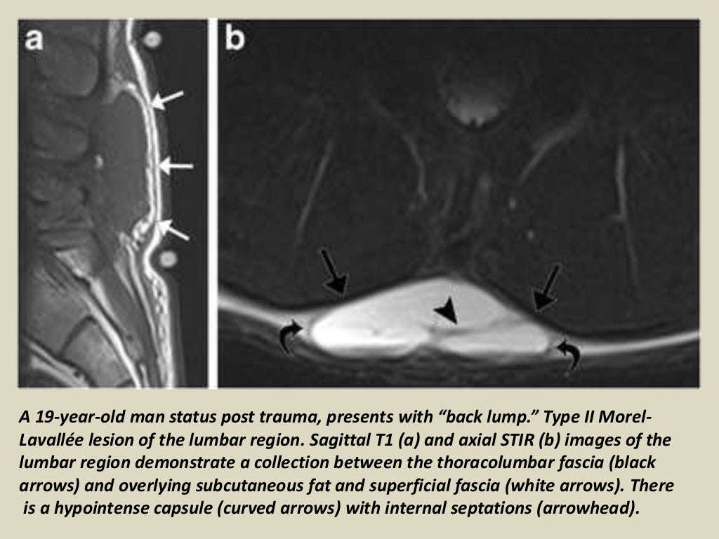 Presentation1, radiological imaging of morel lavallee lesion.