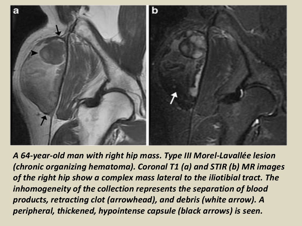 Presentation1, radiological imaging of morel lavallee lesion.
