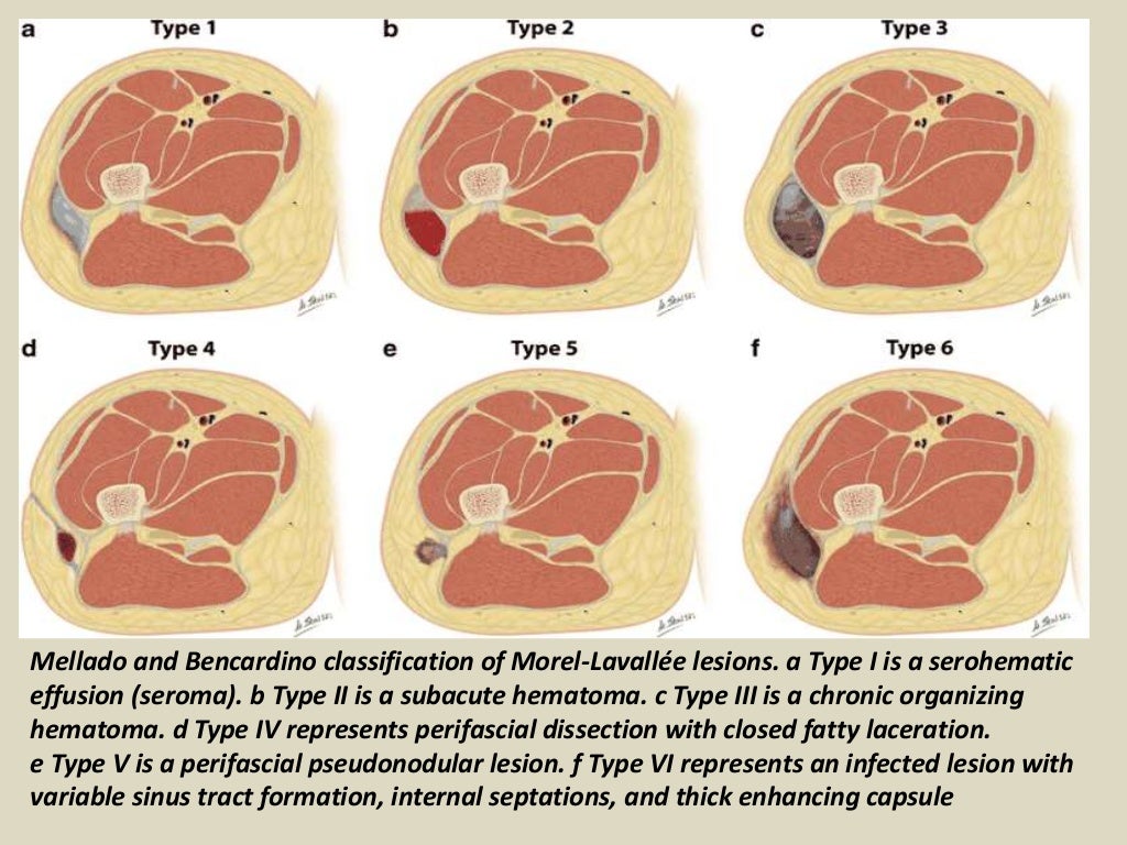 Presentation1, radiological imaging of morel lavallee lesion.