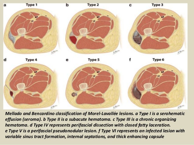 Presentation1, radiological imaging of morel lavallee lesion.
