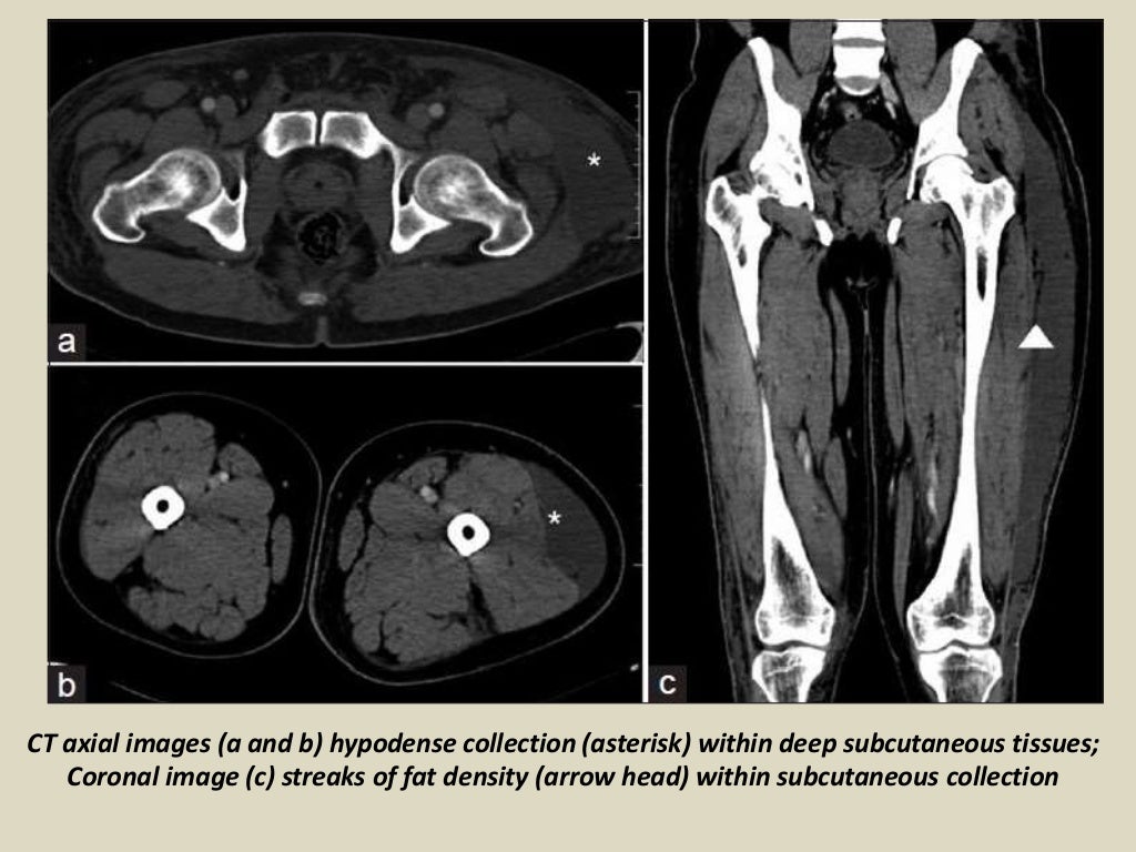 Presentation1, radiological imaging of morel lavallee lesion.
