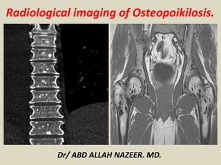 Radiological imaging of Osteopoikilosis.
Dr/ ABD ALLAH NAZEER. MD.
 