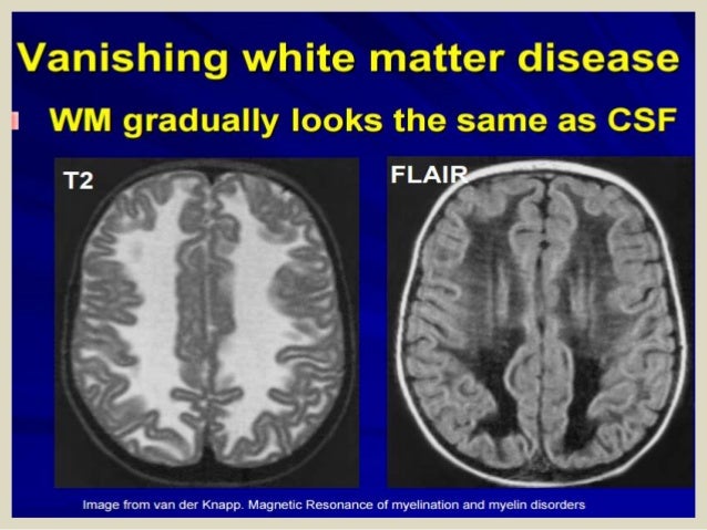 47+ toll Bilder Vanishing White Matter Leukodystrophy / Giving Hope for