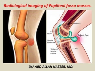 Radiological imaging of Popliteal fossa masses.
Dr/ ABD ALLAH NAZEER. MD.
 