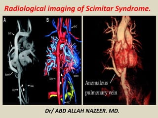 Radiological imaging of Scimitar Syndrome.
Dr/ ABD ALLAH NAZEER. MD.
 