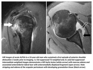 presentation1radiologicalimagingofshoulderdislocation-161021011345.pptx