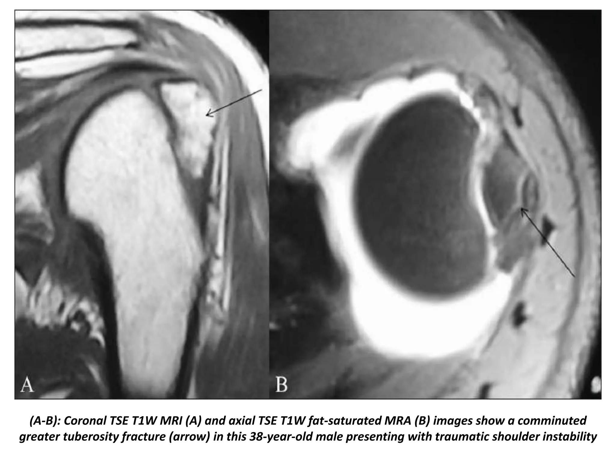 Presentation1, radiological imaging of shoulder dislocation.