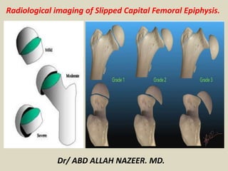 Radiological imaging of Slipped Capital Femoral Epiphysis.
Dr/ ABD ALLAH NAZEER. MD.
 
