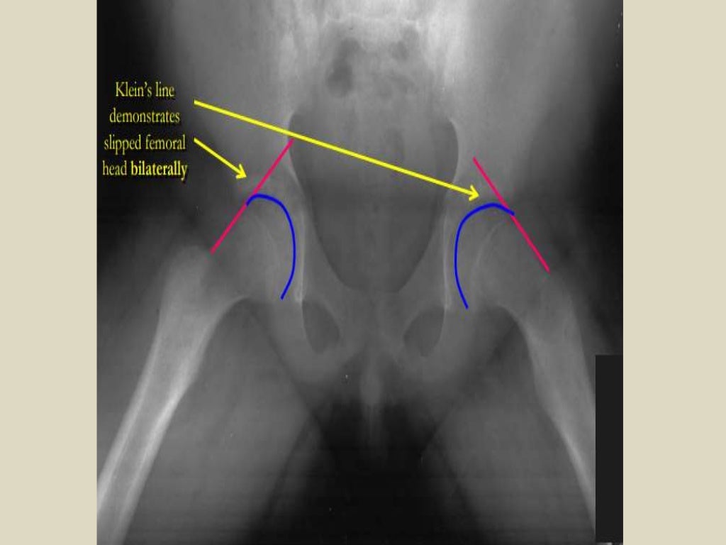Presentation1, radiological imaging of slipped femoral capital epiphy…