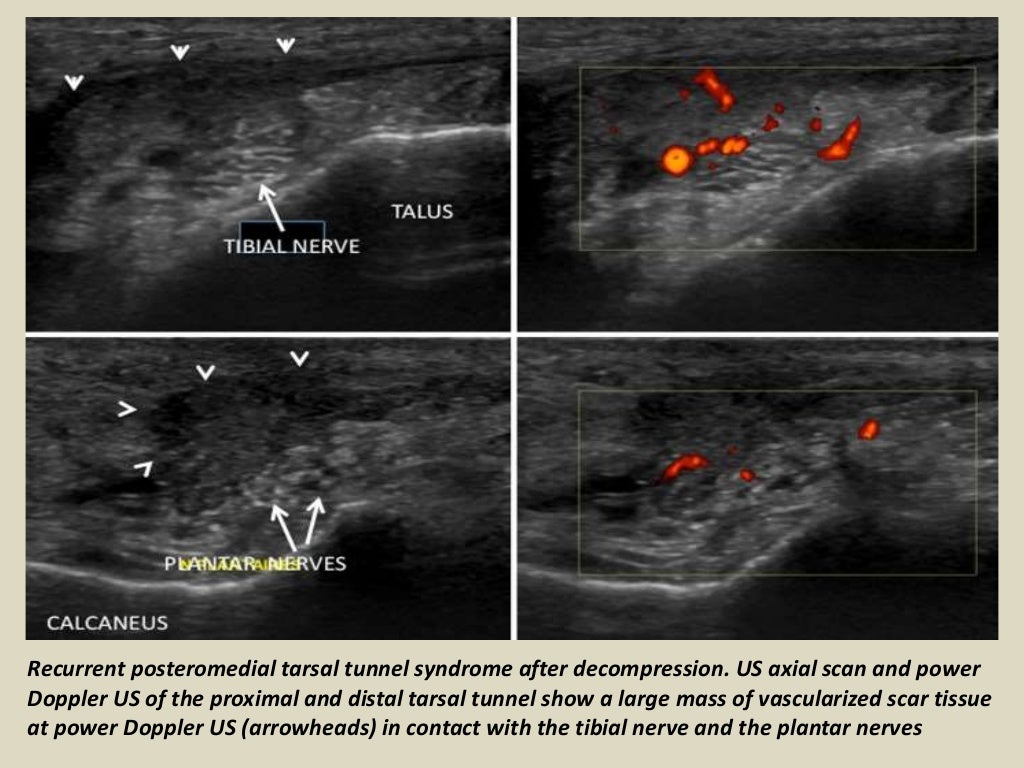 Presentation1 radiological imaging of tarsal tunnel syndrome.