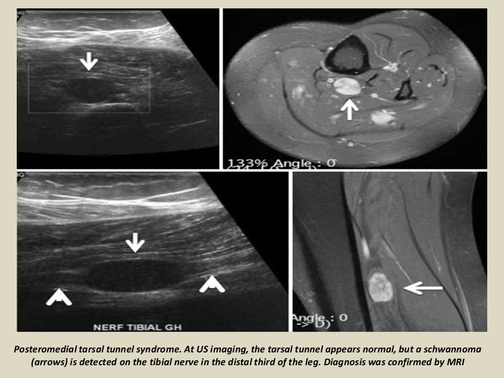 Presentation1 radiological imaging of tarsal tunnel syndrome.