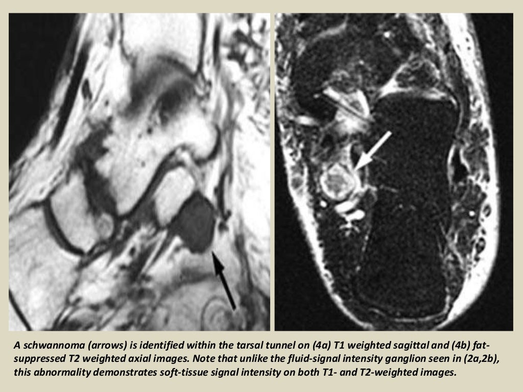 Presentation1 radiological imaging of tarsal tunnel syndrome.