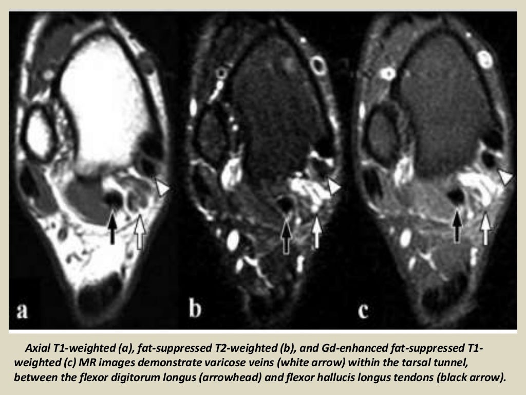 Presentation1 radiological imaging of tarsal tunnel syndrome.