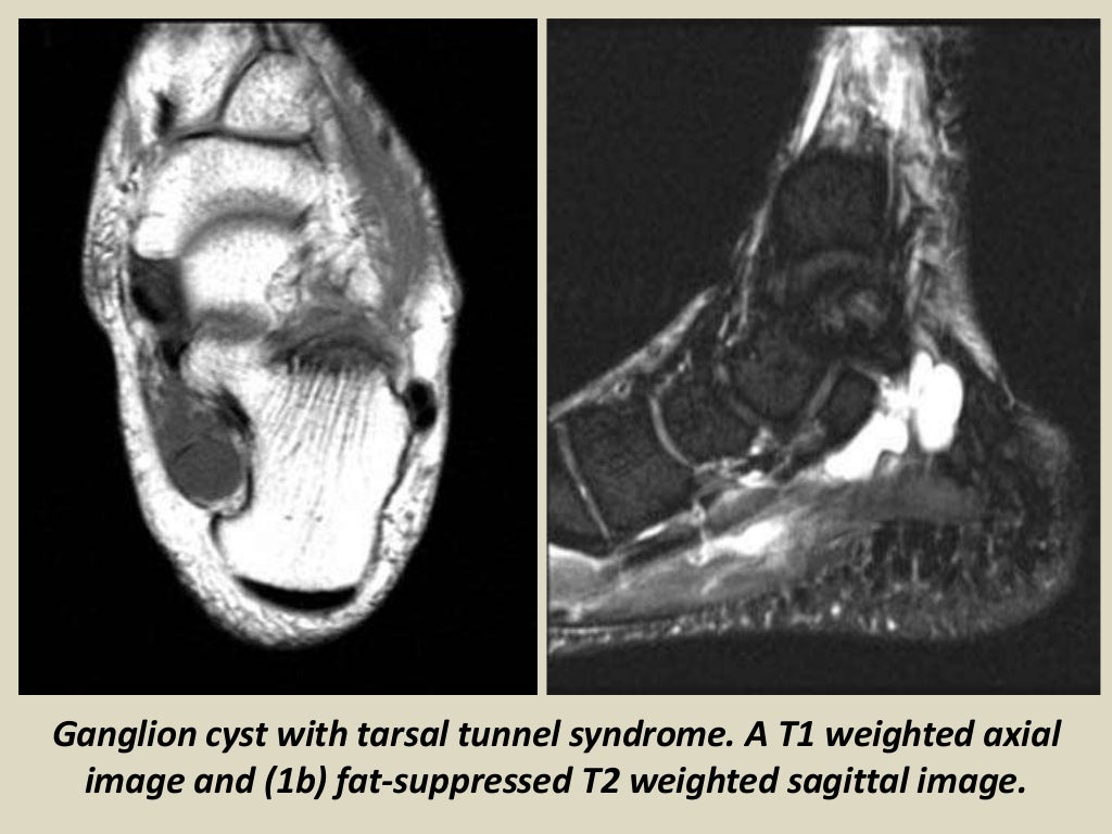 Presentation1 radiological imaging of tarsal tunnel syndrome.