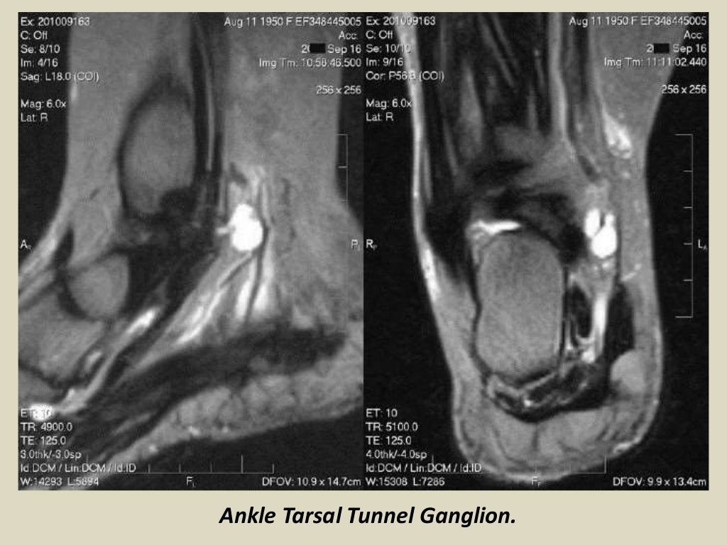 Presentation1 radiological imaging of tarsal tunnel syndrome.