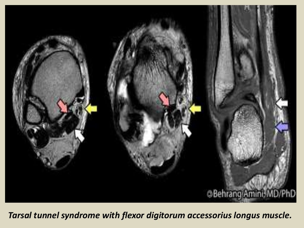 Presentation1 radiological imaging of tarsal tunnel syndrome.