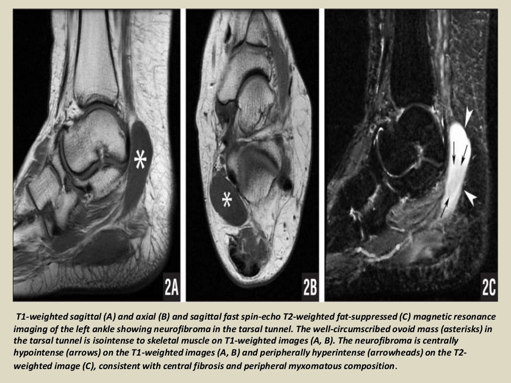 Presentation1 radiological imaging of tarsal tunnel syndrome.