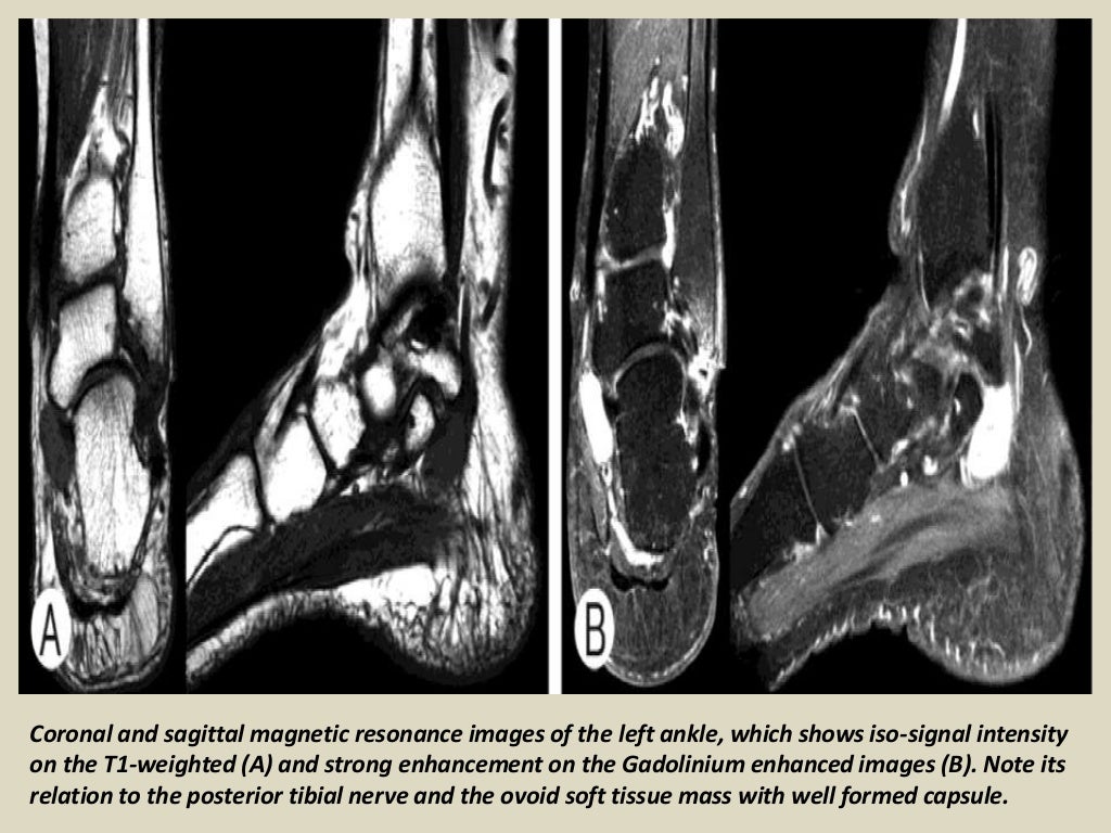 Presentation1 radiological imaging of tarsal tunnel syndrome.