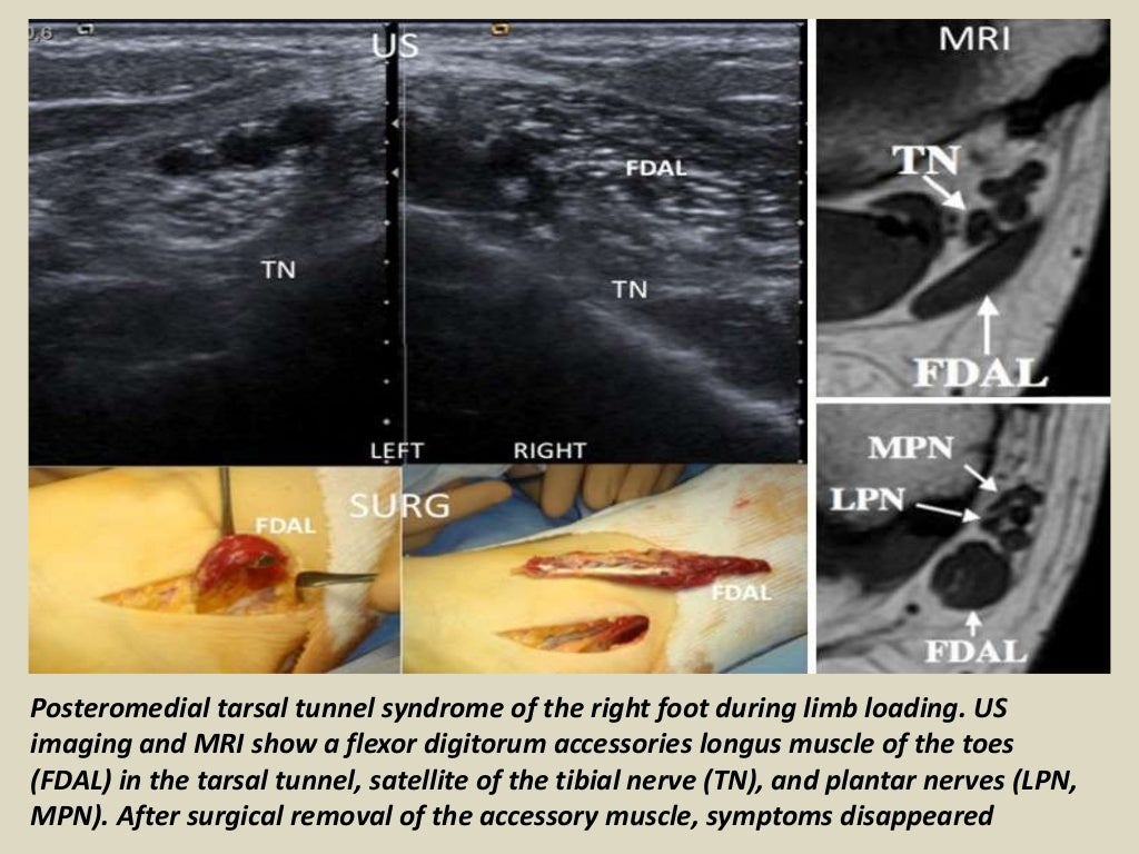 Presentation1 radiological imaging of tarsal tunnel syndrome.