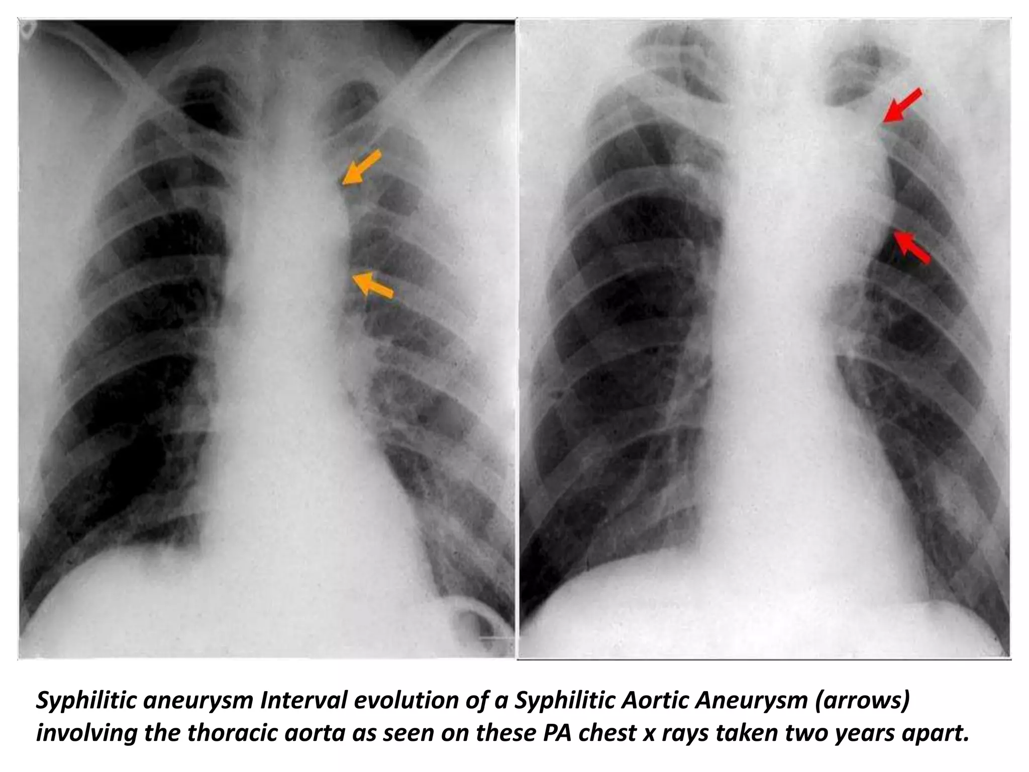 Presentation1, radiological imaging of thoracic aortic aneurysm. | PPTX