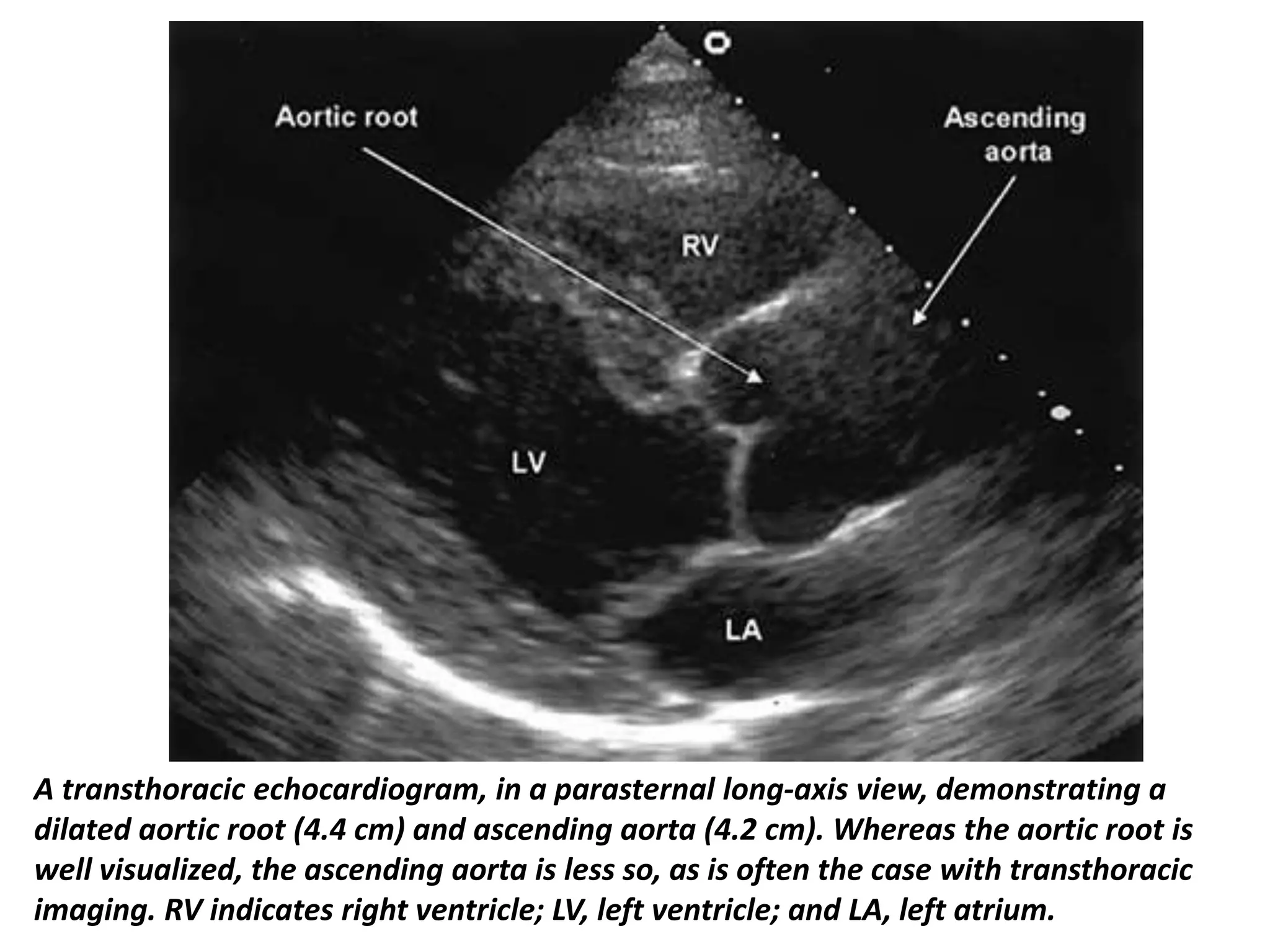 Presentation1, radiological imaging of thoracic aortic aneurysm. | PPTX