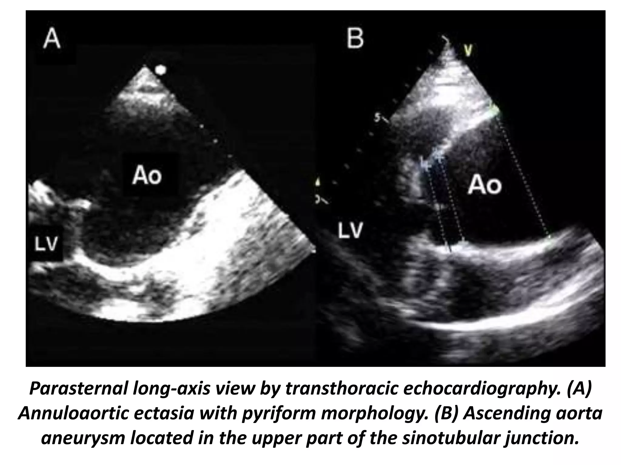 Presentation1, radiological imaging of thoracic aortic aneurysm. | PPTX