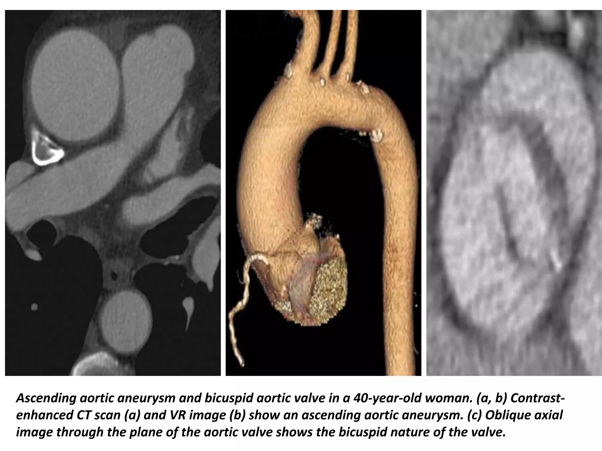 Presentation1, radiological imaging of thoracic aortic aneurysm. | PPTX