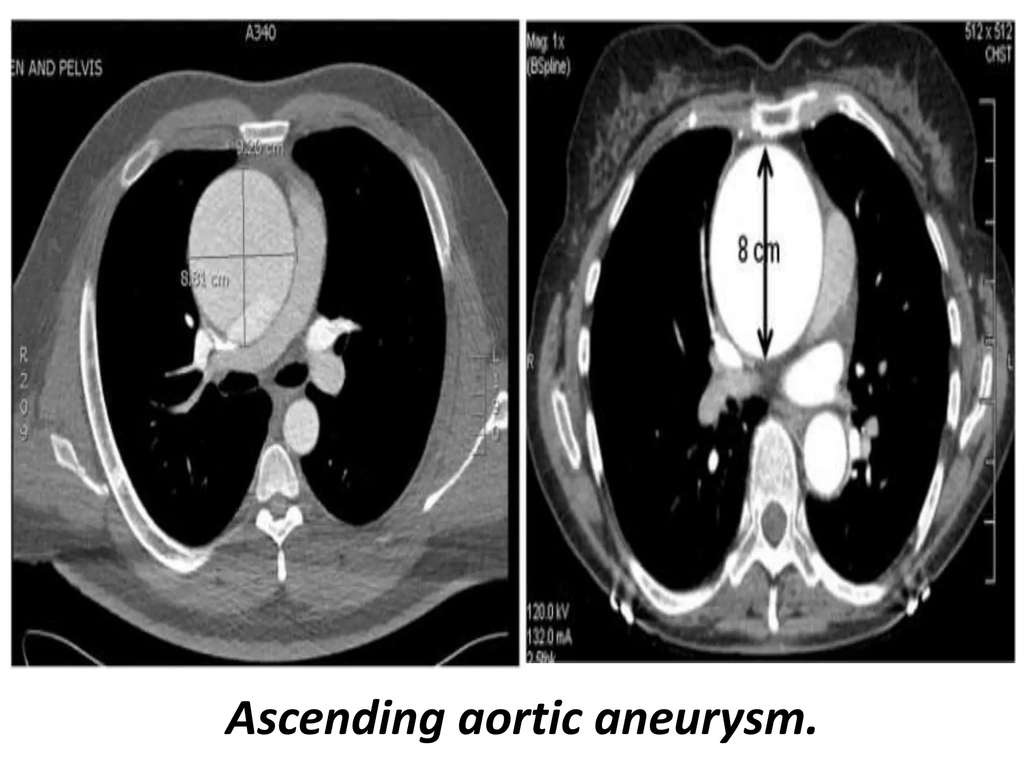 Presentation1, radiological imaging of thoracic aortic aneurysm. | PPTX