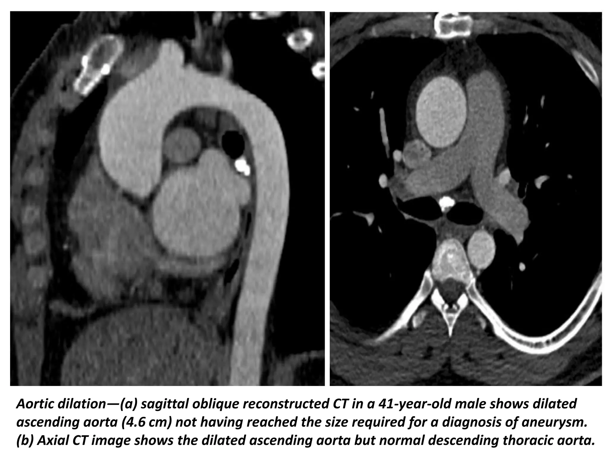 Presentation1, radiological imaging of thoracic aortic aneurysm. | PPTX