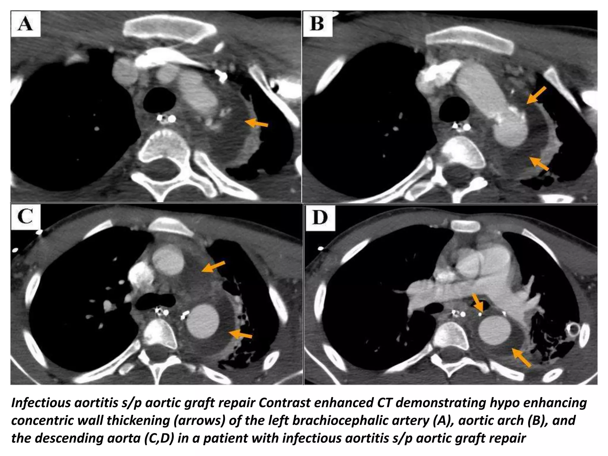 Presentation1, radiological imaging of thoracic aortic aneurysm. | PPTX