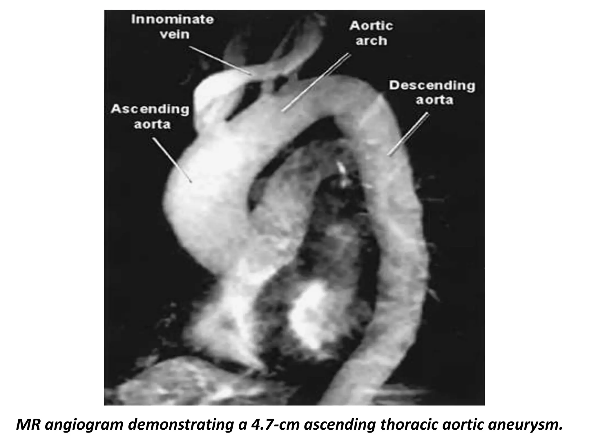 Presentation1, radiological imaging of thoracic aortic aneurysm. | PPTX
