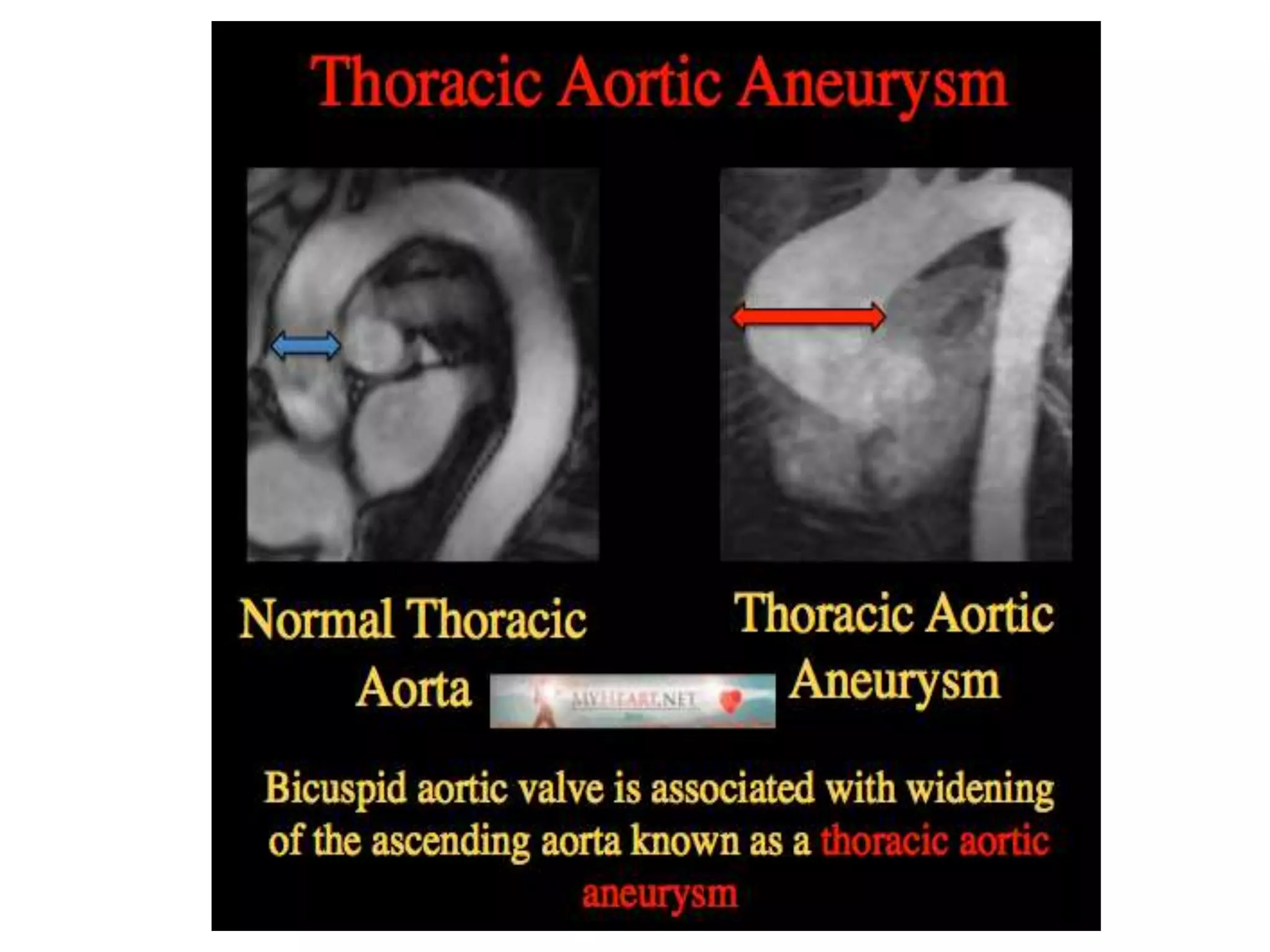 Presentation1, radiological imaging of thoracic aortic aneurysm. | PPTX