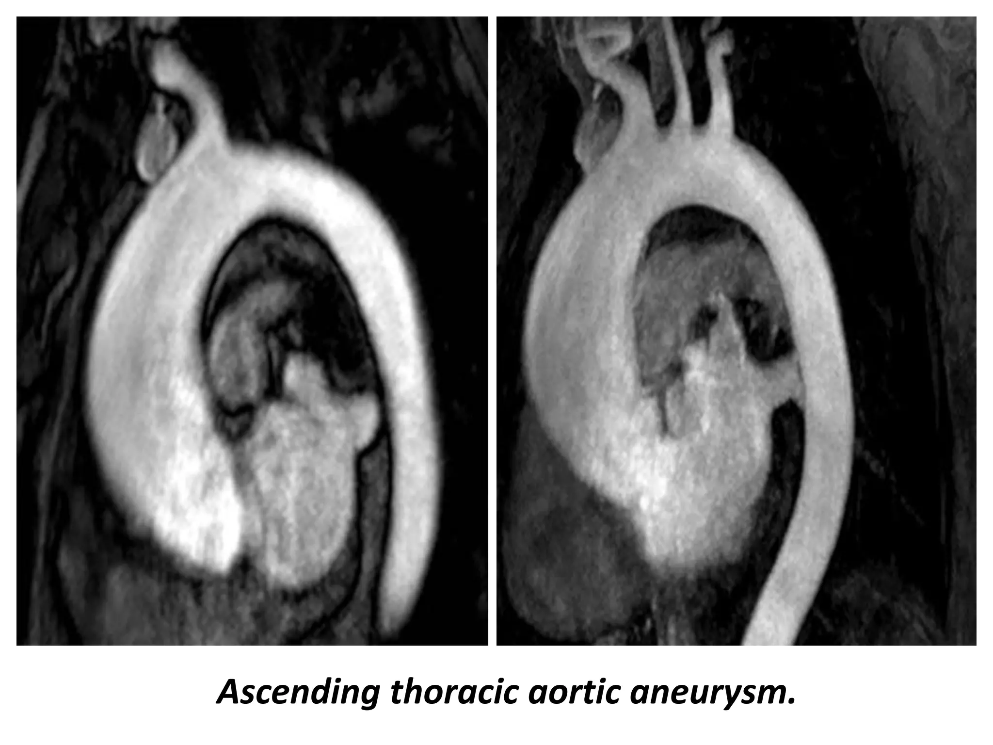 Presentation1, radiological imaging of thoracic aortic aneurysm. | PPTX