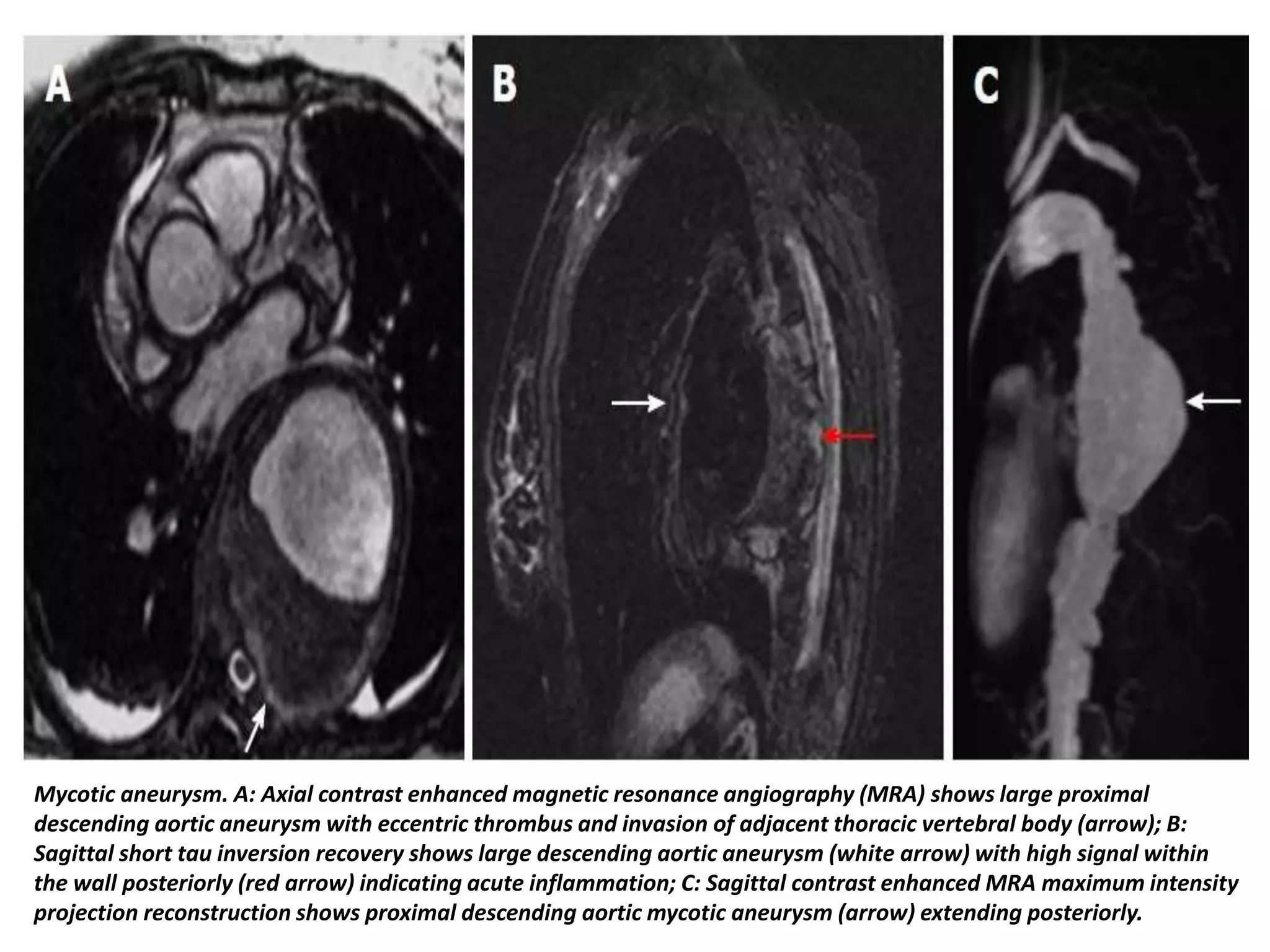 Presentation1, radiological imaging of thoracic aortic aneurysm. | PPTX