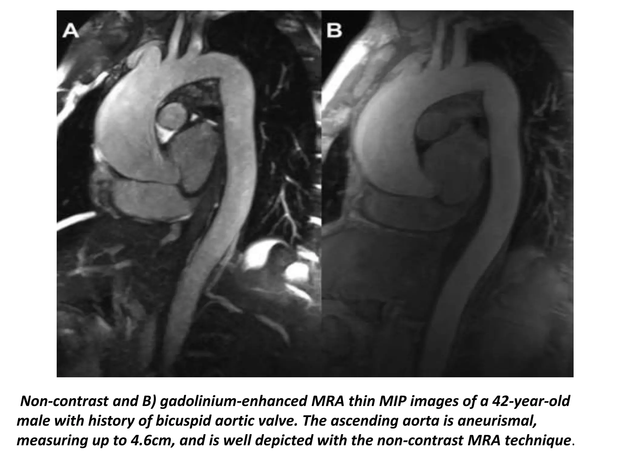 Presentation1, radiological imaging of thoracic aortic aneurysm. | PPTX